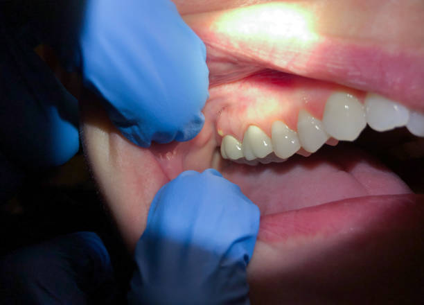 Best Tooth Infection Emergency Dentist  in Country Clu, CA
